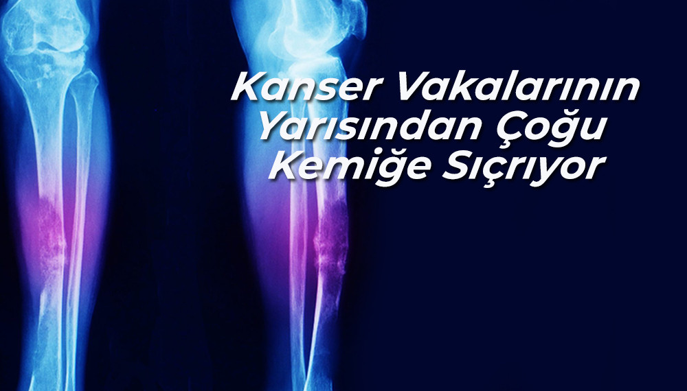           Kanser Vakalarının Yarısından Çoğu Kemiğe Sıçrıyor